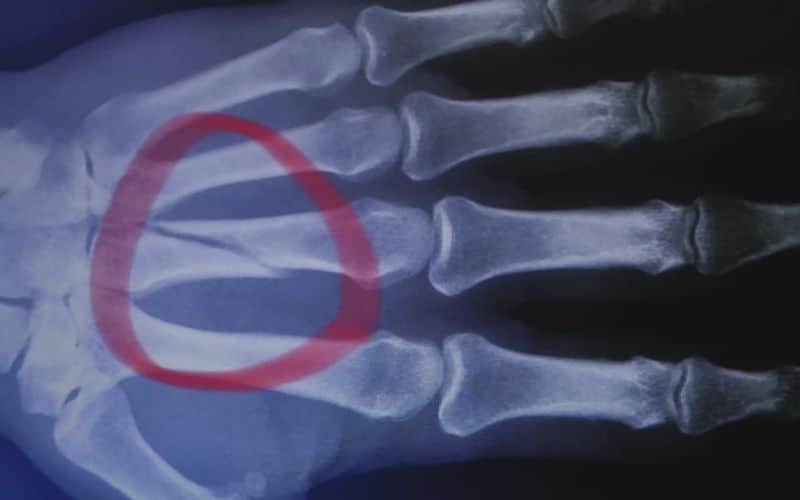 Bone Fractures