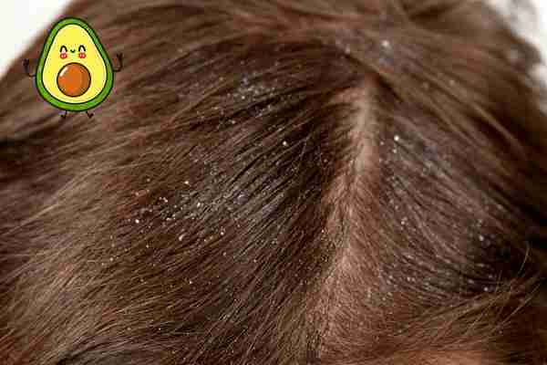 Avocado for dandruff
