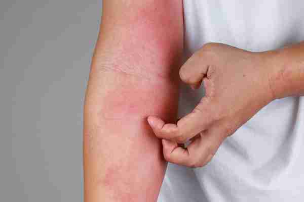eczema and dry skin